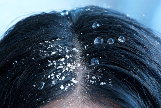 How chlorine in Indian shower water dries the scalp and causes flaking, and how a filter helps